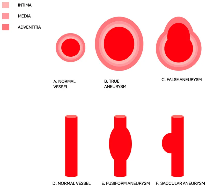 Types of Aneurysms: True, False, Fusiform, Saccular