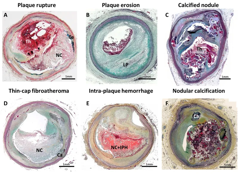 Histological cross-sections of atherosclerotic plaques