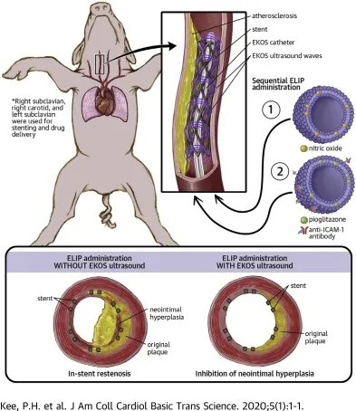 In-stent restenosis vs. inhibition of neointimal hyperplasia
