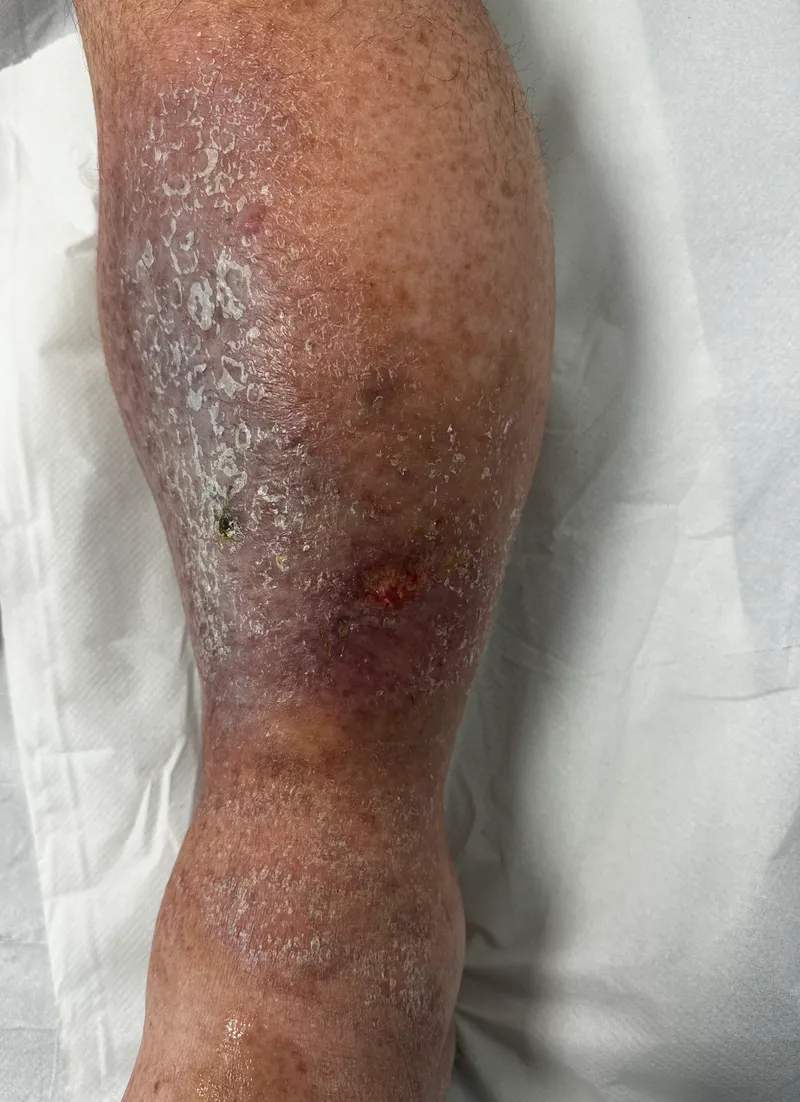 Stasis dermatitis and venous ulcer