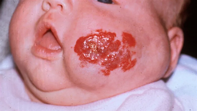 Infantile hemangioma on infant face