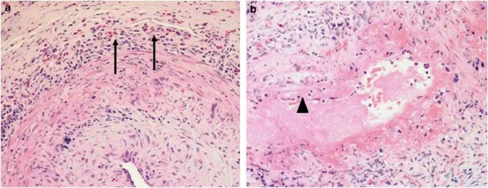 Giant Cell Arteritis: Temporal Artery Biopsy Histology