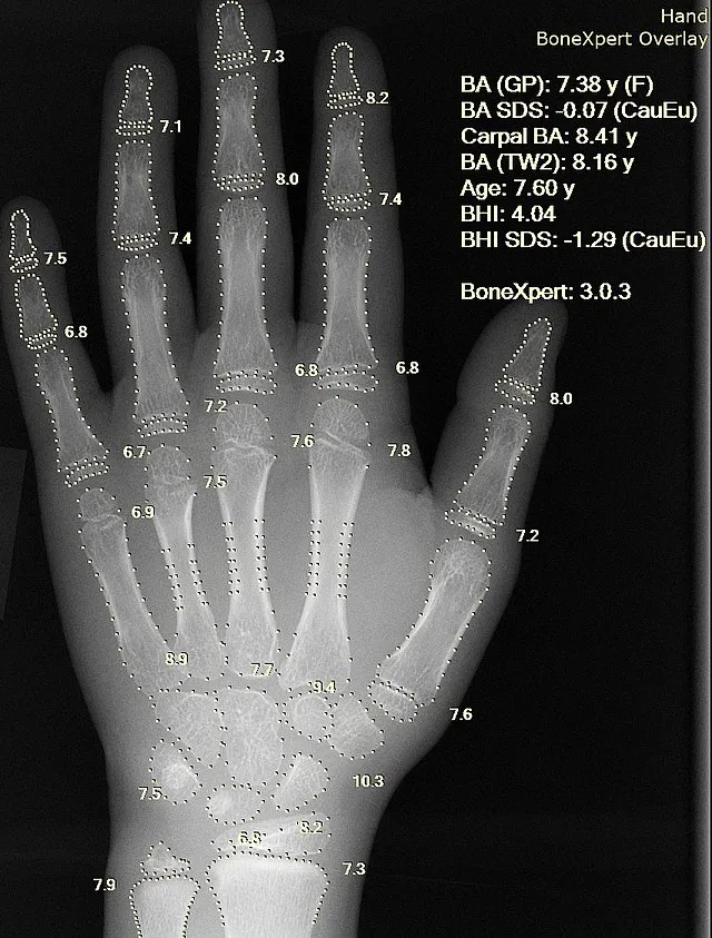 X-ray left hand and wrist with bone age overlay