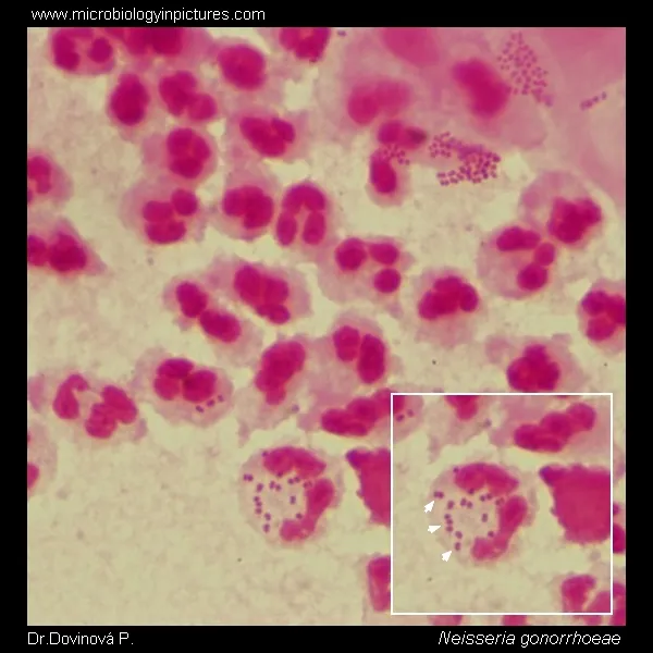 Neisseria gonorrhoeae Gram Stain