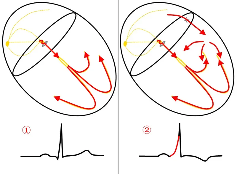WPW syndrome accessory pathway and delta wave ECG