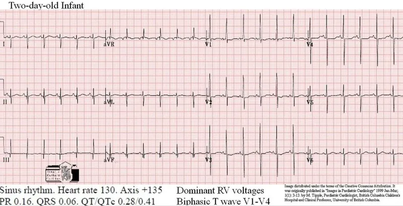 ECG of two-day-old infant with normal findings