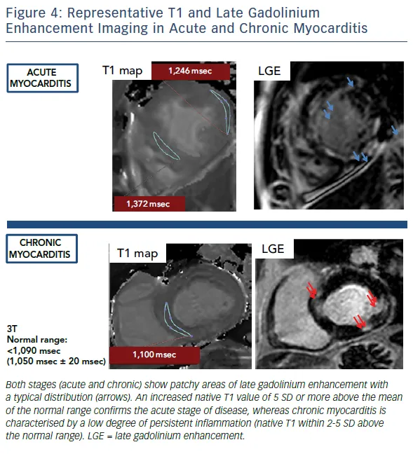 Cardiac MRI: Acute vs Chronic Myocarditis