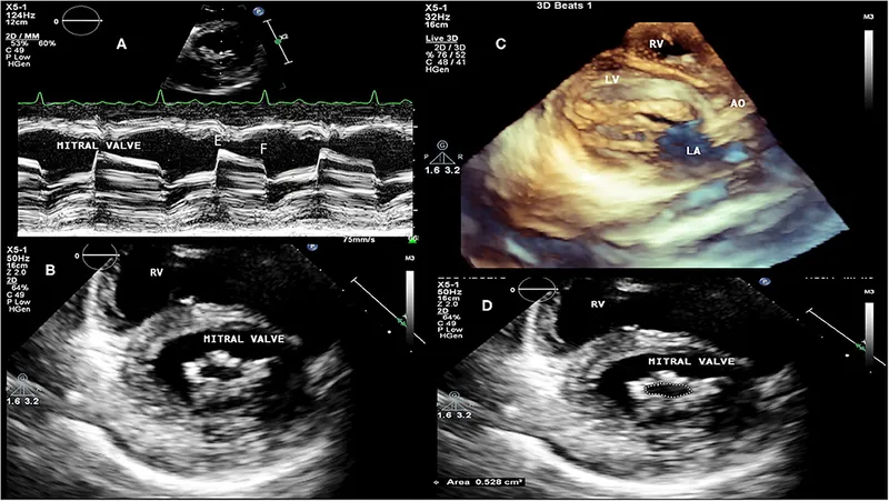Echocardiogram of mitral stenosis in RHD