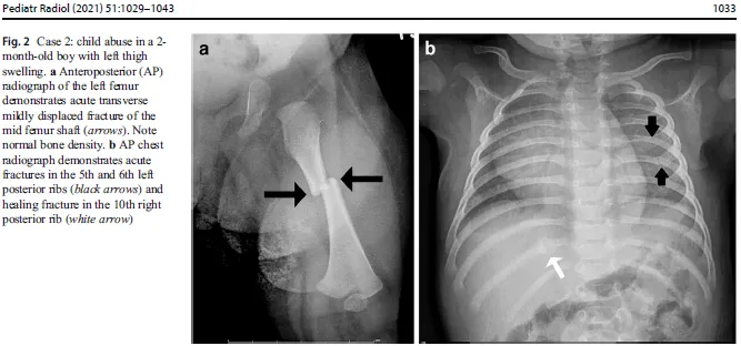 X-ray: Femur shaft fracture and posterior rib fractures