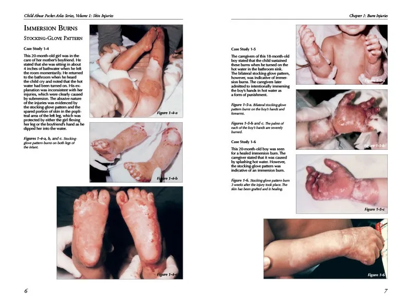 Immersion burns: stocking-glove pattern