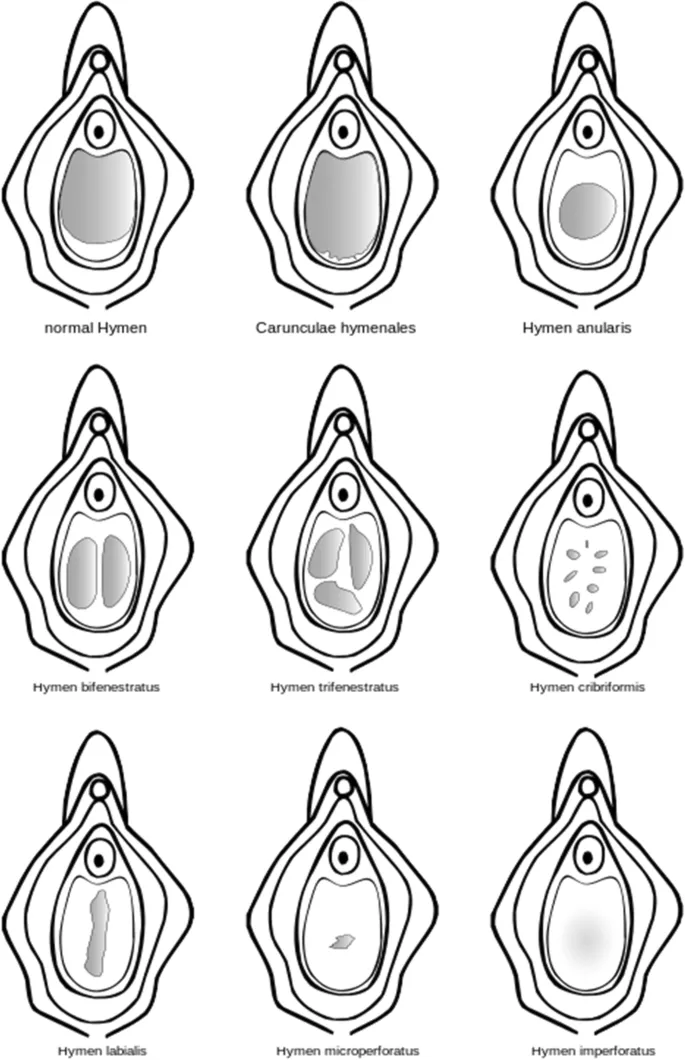 Normal hymen and hymen variants