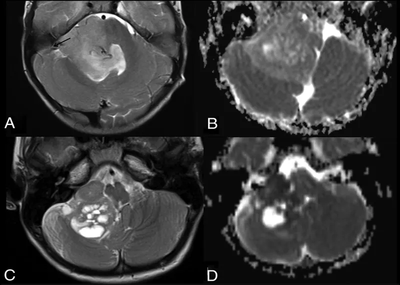 MRI of posterior fossa brain tumor in a child