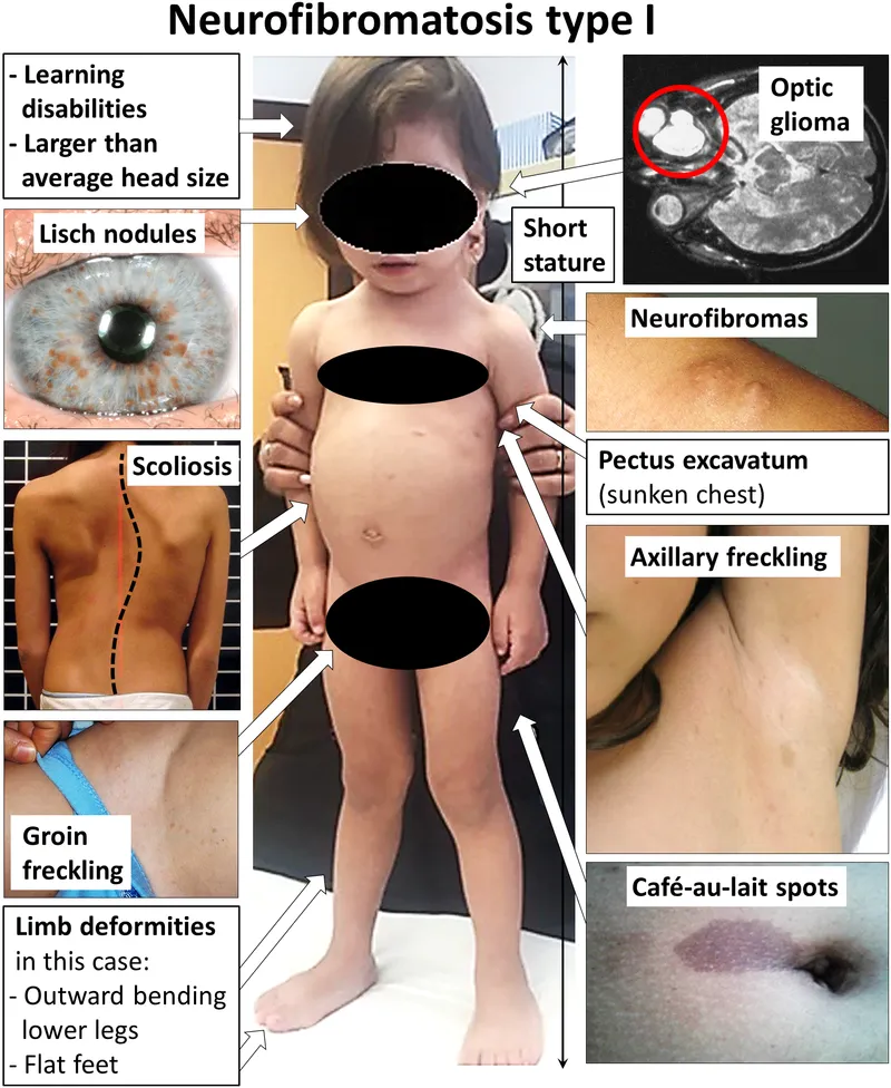 Clinical features of Neurofibromatosis Type 1