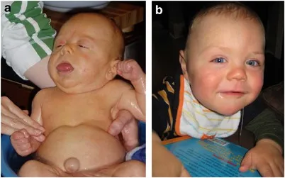Beckwith-Wiedemann Syndrome: Macroglossia and Omphalocele