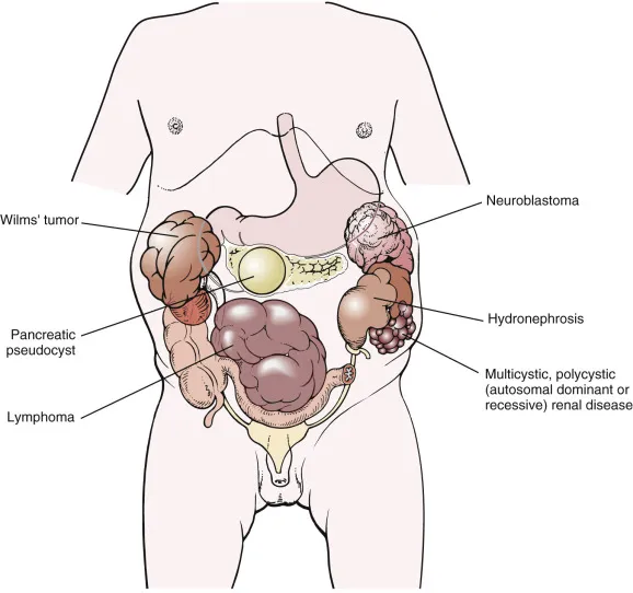 Abdominal masses in children: Wilms, neuroblastoma, lymphoma