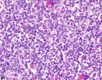 Ewing sarcoma histology: small round blue cells