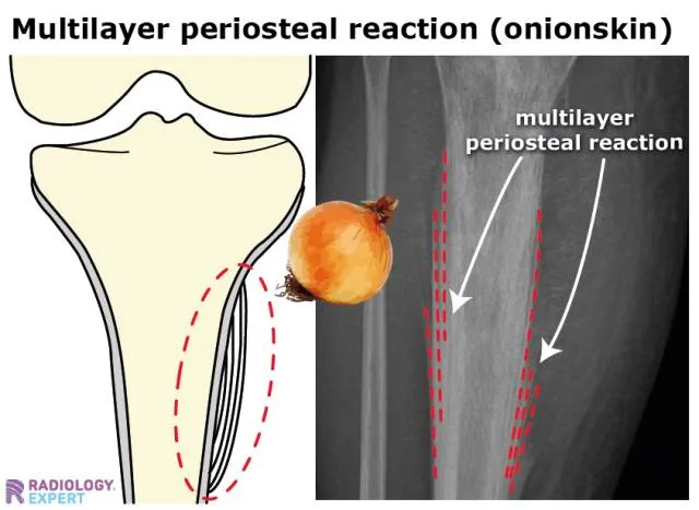 Multilayer periosteal reaction (onion skin) on X-ray