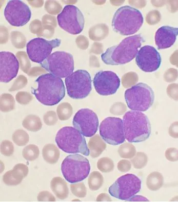 Peripheral smear: Acute Lymphoblastic Leukemia (ALL)