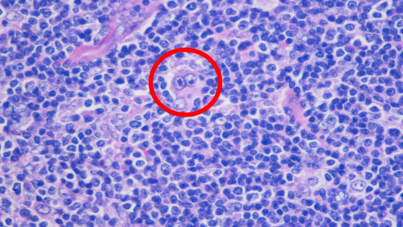 Hodgkin's Lymphoma: Reed-Sternberg cell (H&E stain)