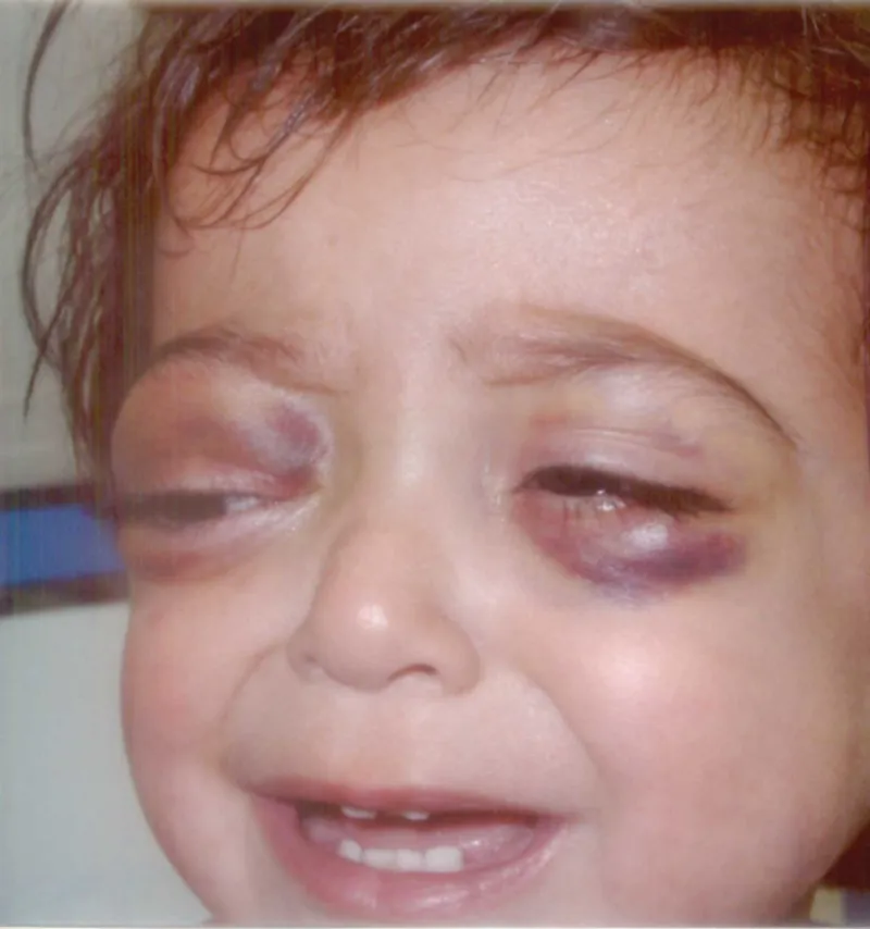 Raccoon Eyes and Proptosis in Neuroblastoma