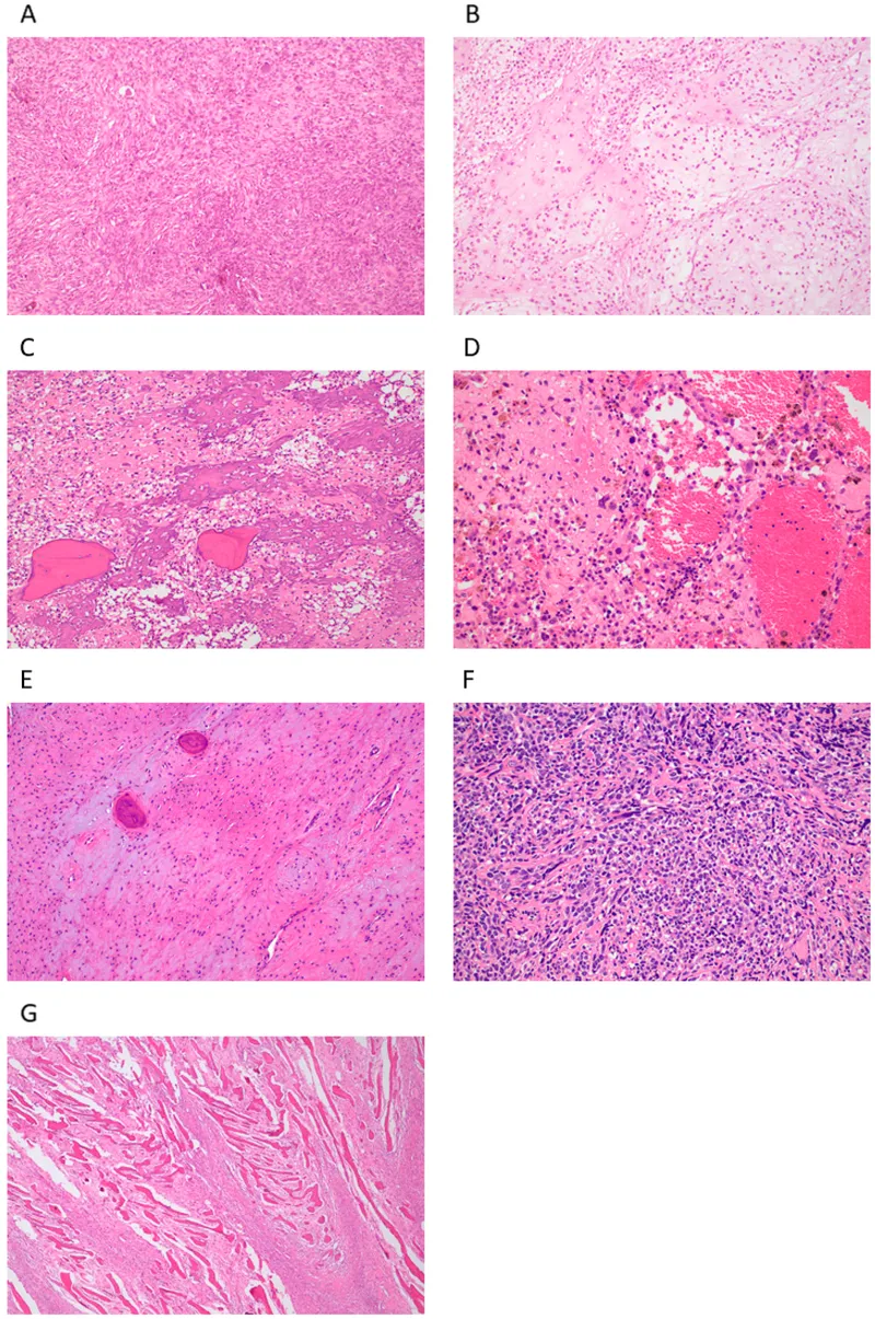 Histopathology of osteosarcoma showing malignant osteoid