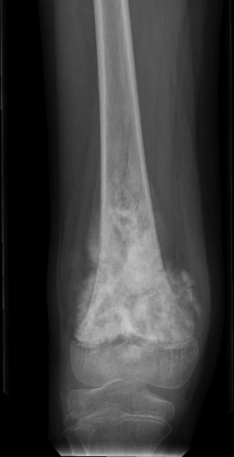 X-ray: Osteosarcoma of distal femur with Codman triangle