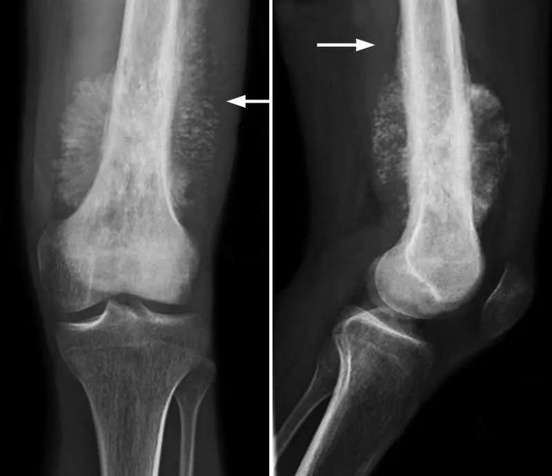 X-ray: Osteosarcoma with Codman triangle & sunburst pattern