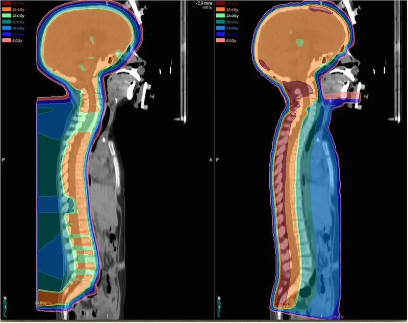 Photon vs. Proton Beam Therapy Dose Deposition in Child