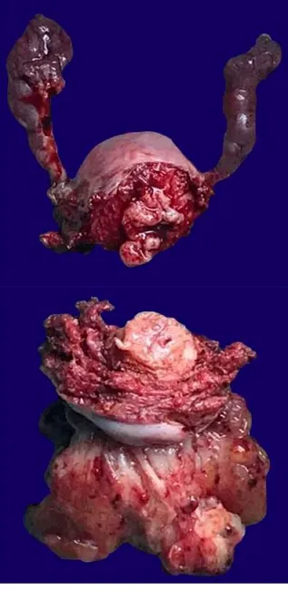 Sarcoma botryoides gross specimen with grape-like masses