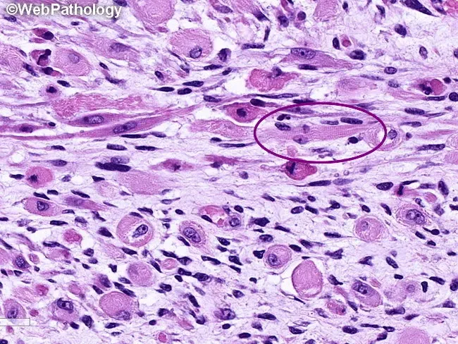 Embryonal Rhabdomyosarcoma Histopathology with Strap Cells