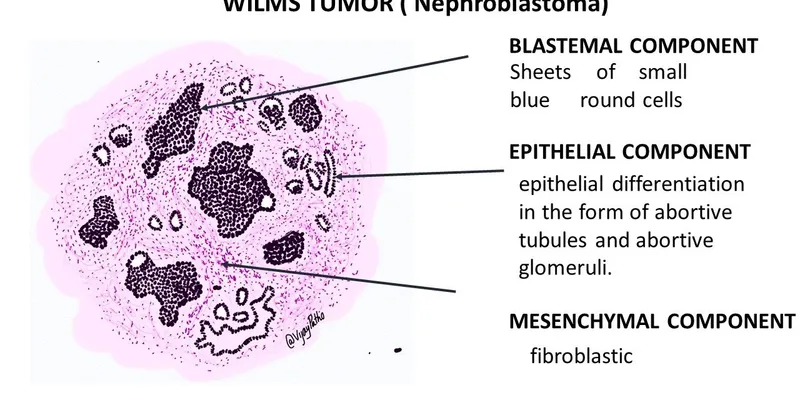 Triphasic Wilms Tumor Histopathology