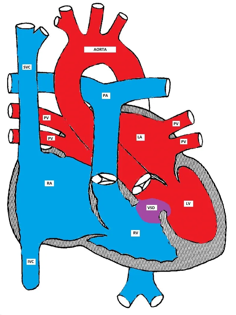 Heart with VSD and left-to-right shunt