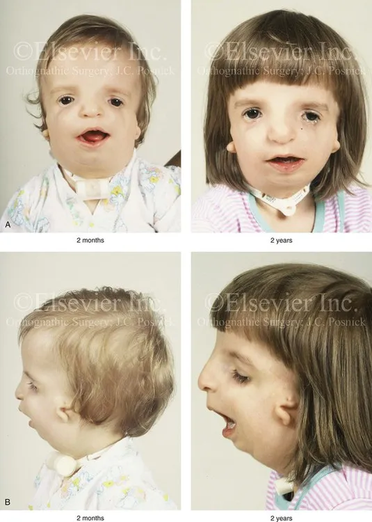 Treacher Collins Syndrome: 2 months vs. 2 years