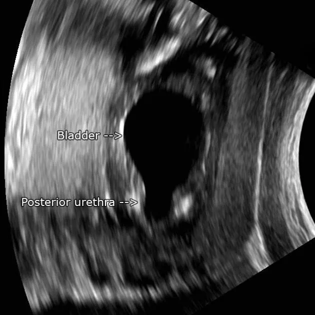 Antenatal US: Keyhole sign in posterior urethral valves