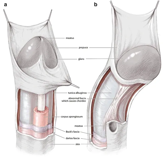 Hypospadias vs. Normal Penile Anatomy