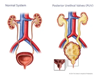 Normal vs. PUV Urinary System