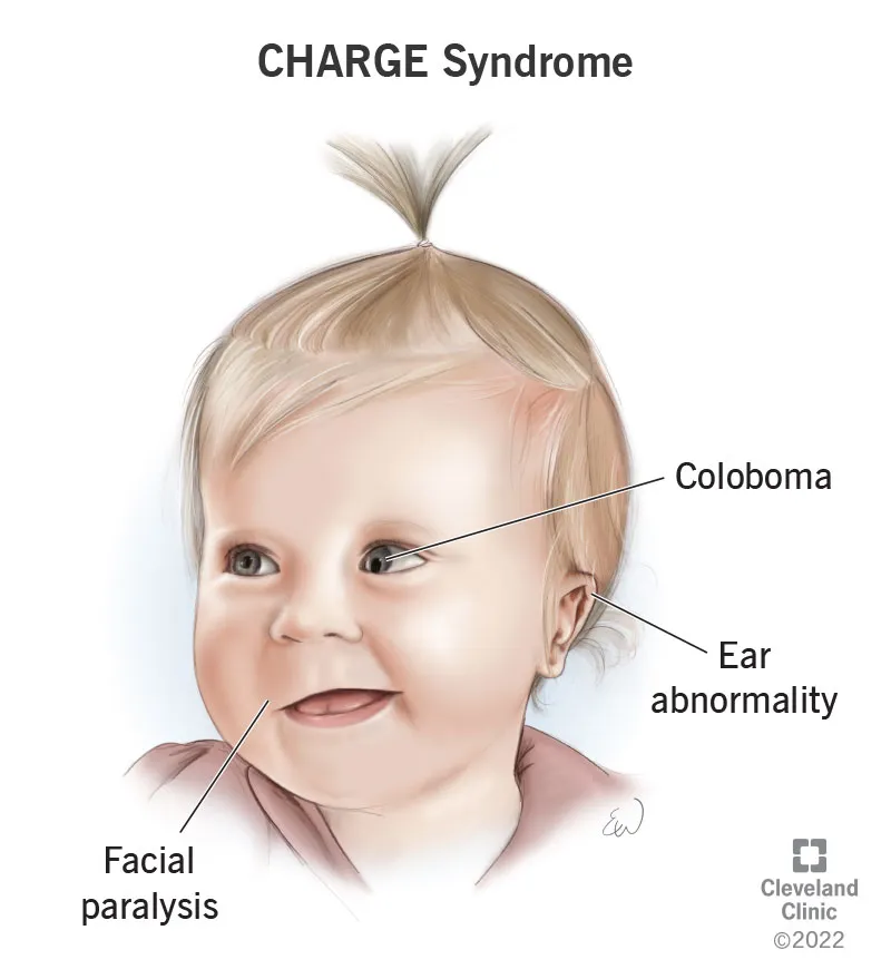 CHARGE Syndrome: Facial features, coloboma, ear abnormality
