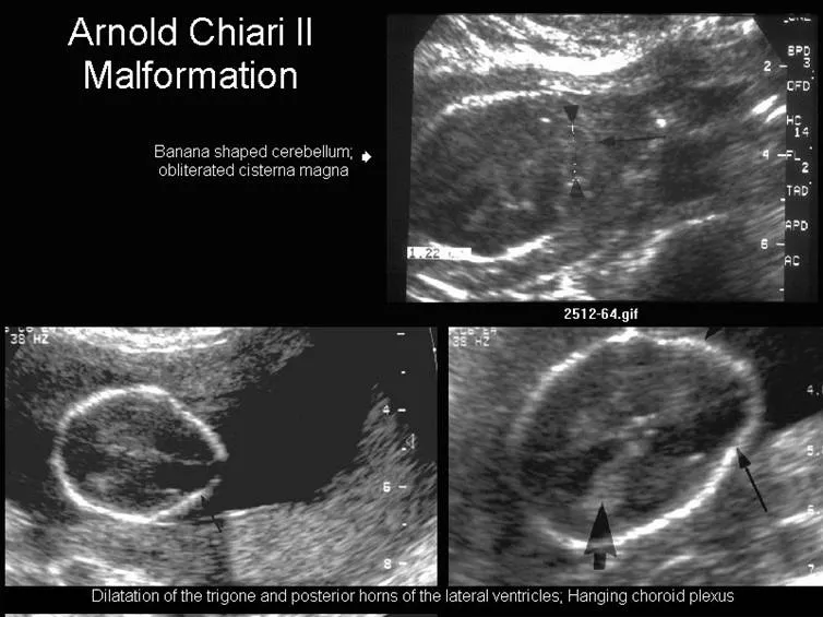 Ultrasound of Chiari II malformation with lemon/banana signs
