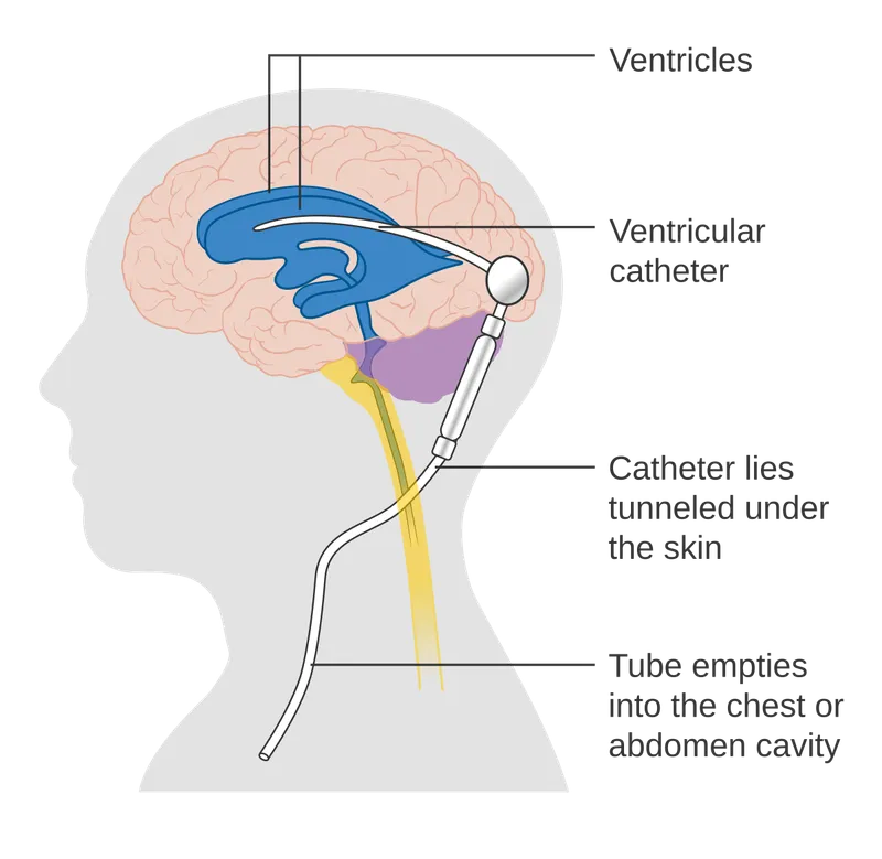 Ventriculoperitoneal (VP) Shunt Diagram