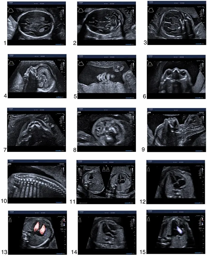 Fetal ultrasound images for prenatal anomaly detection