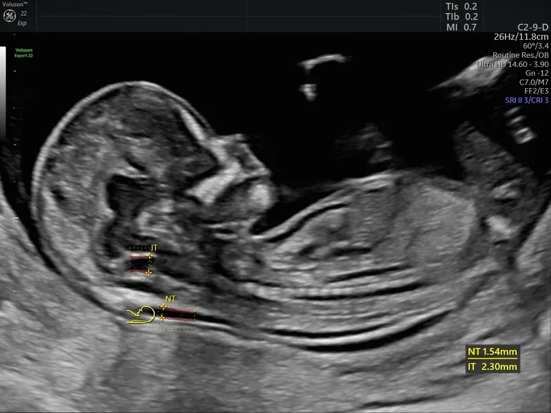 Fetal Nuchal Translucency (NT) Ultrasound Measurement