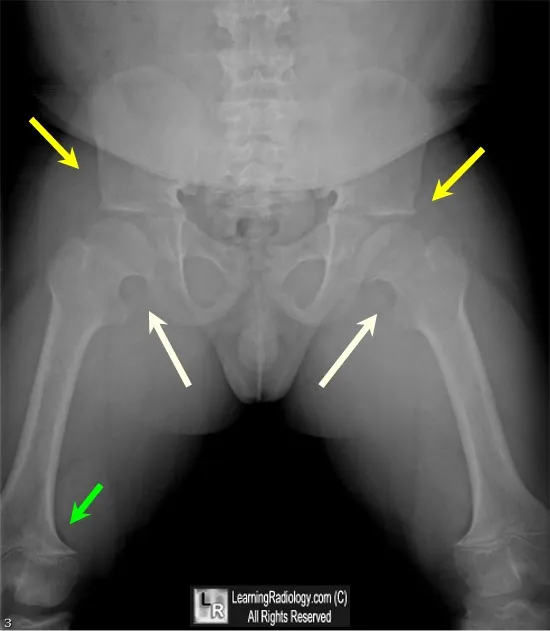 Achondroplasia X-ray: Pelvis and Trident Hand