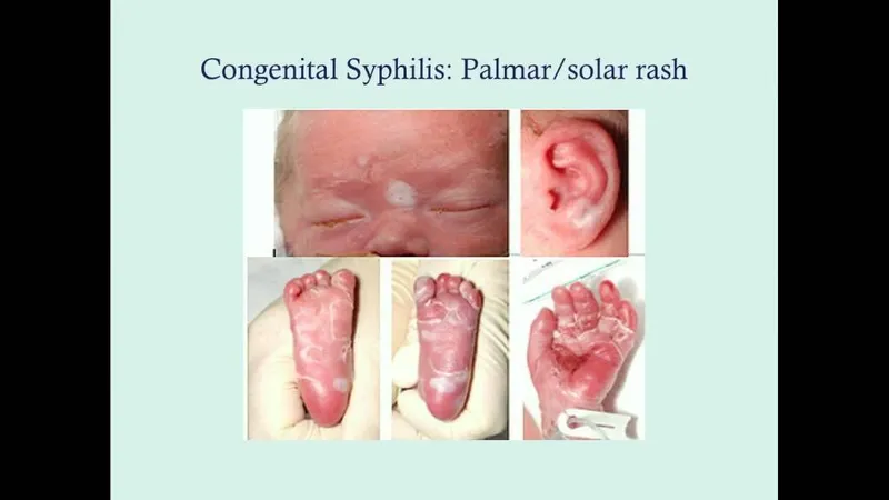 Congenital Syphilis: Palmar/Solar Rash in Newborn