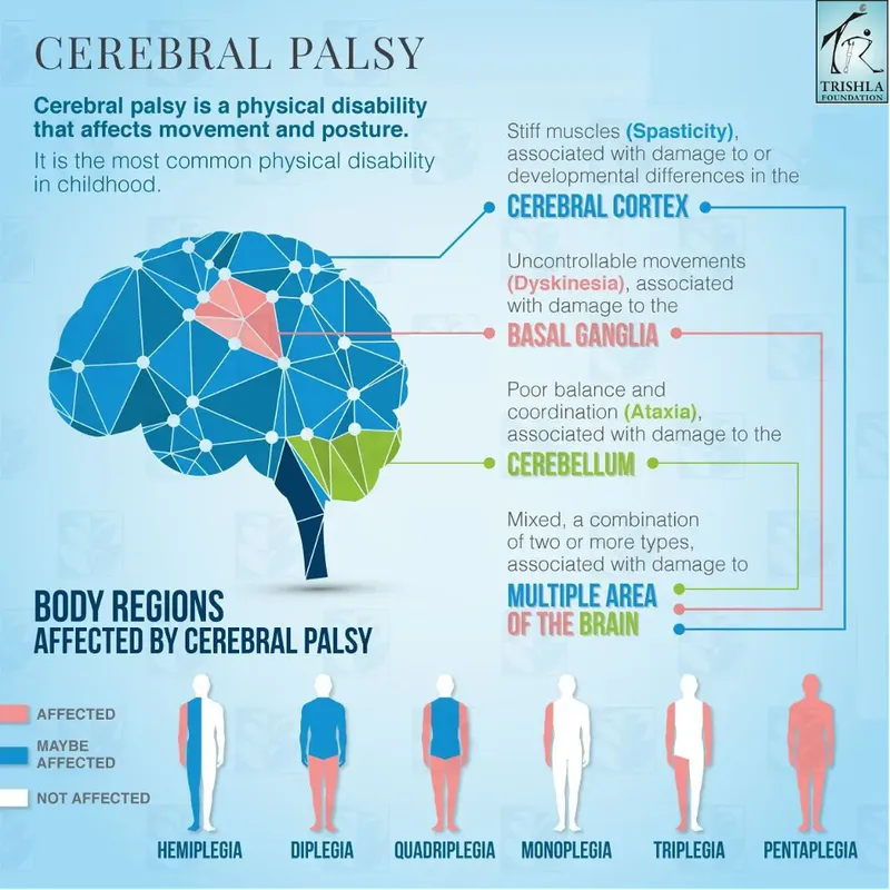 Cerebral Palsy Types, Brain Areas, and Body Regions