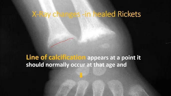 X-ray of healed rickets