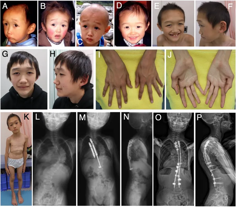 Sotos syndrome features and scoliosis treatment