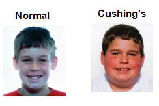 Normal vs Cushing's in children