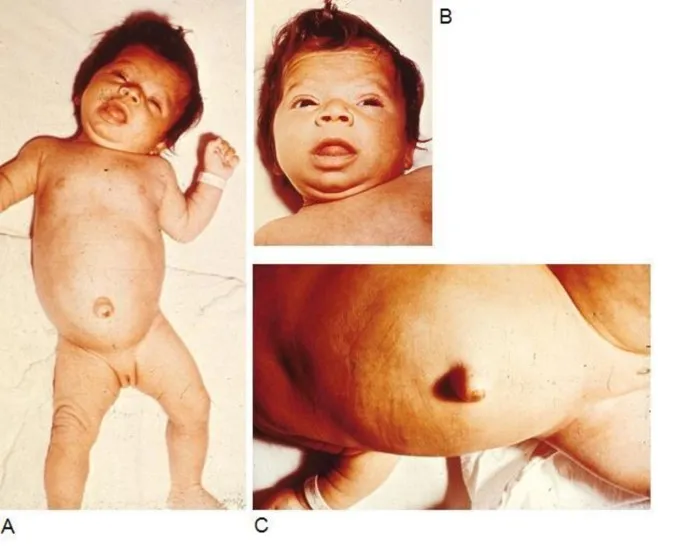 Neonate with congenital hypothyroidism features
