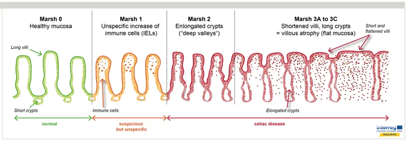 Marsh Classification of Celiac Disease Histology