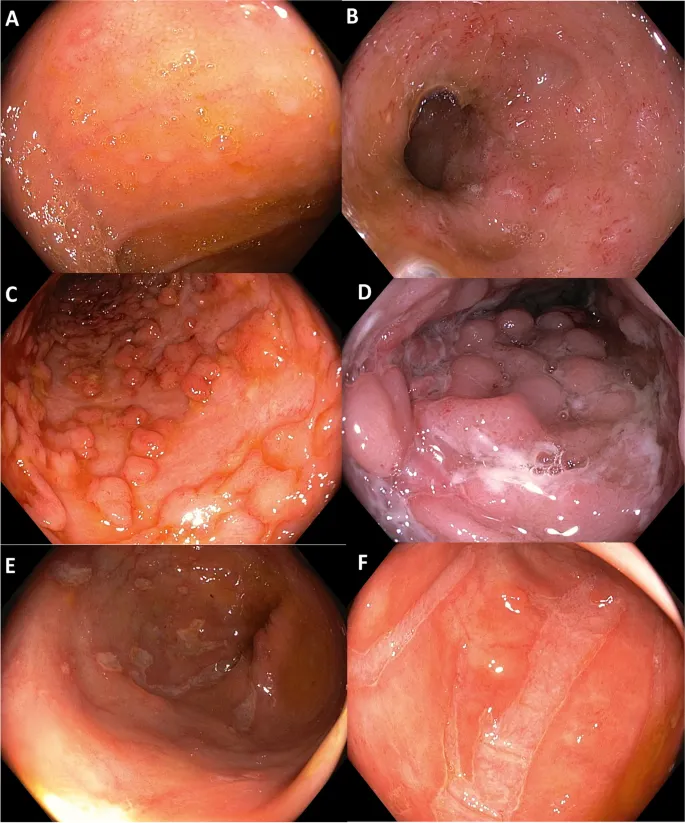 Endoscopic views of Crohn's disease